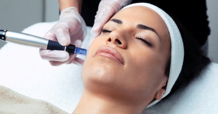 MICRONEEDLING